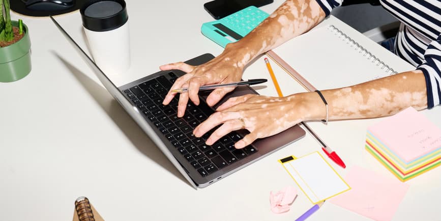 Hands on a laptop Crop of business worker with vitiligo arms typing on her laptop with a pen in hand, Unrecognizable businesswoman working at white desk with calculator, mug of coffee, mobile phone, notebook and adhesive stickers.