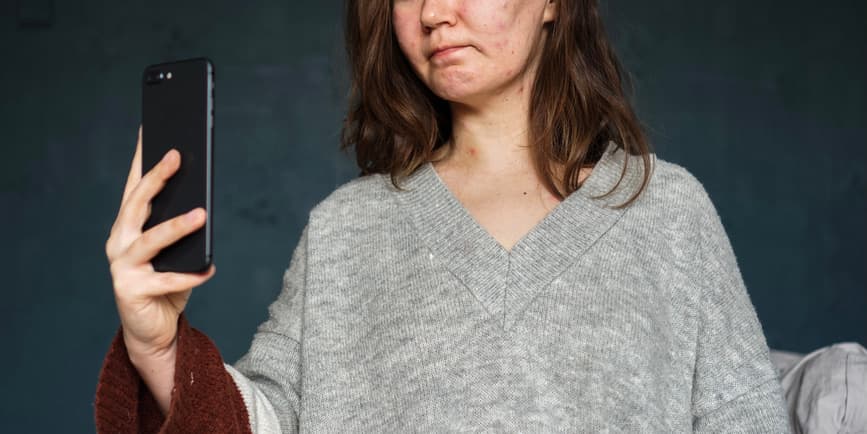 Female infected with varicella (chickenpox) virus being upset with her face and chest covered with inflamed acne pimples, taking a selfie